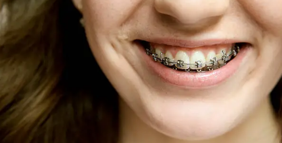 dental braces Adelaide